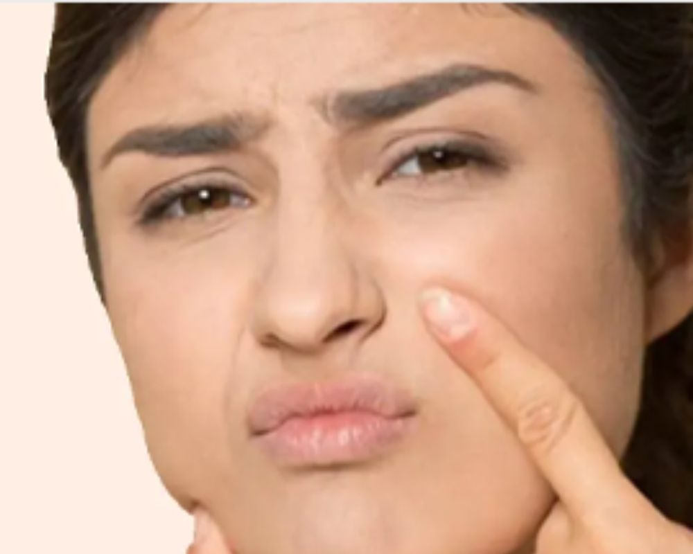 Why am i getting acne in my 30s